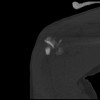 SPORK, NICO - 22.03.1976 - 02.08.2022 - CT obere Extremität - 17:59:07